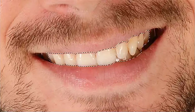 выделение зубов