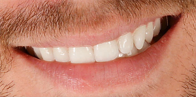 светлые области вокруг зубов